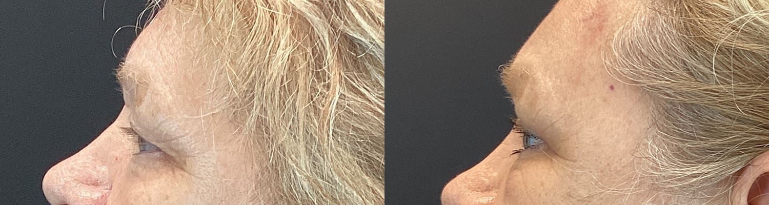 Eyelid Surgery Before & After