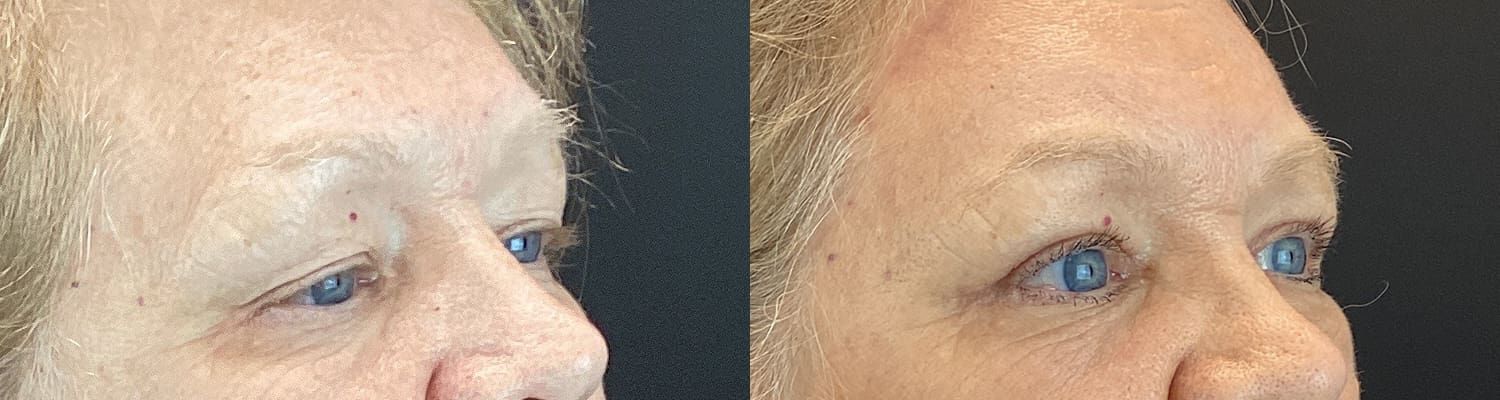 Eyelid Surgery Before & After
