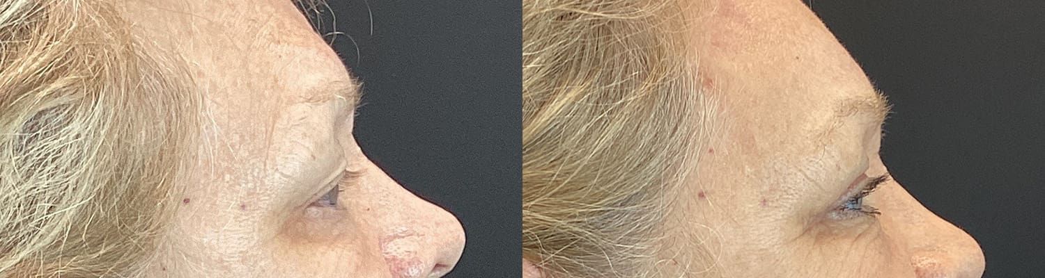 Eyelid Surgery Before & After