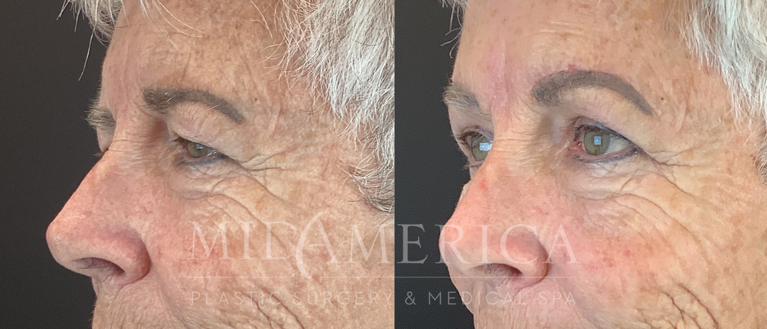 Eyelid Surgery Before & After
