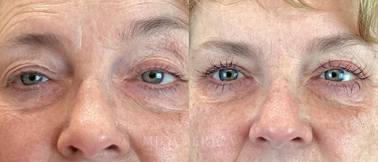 Eyelid Surgery Before & After