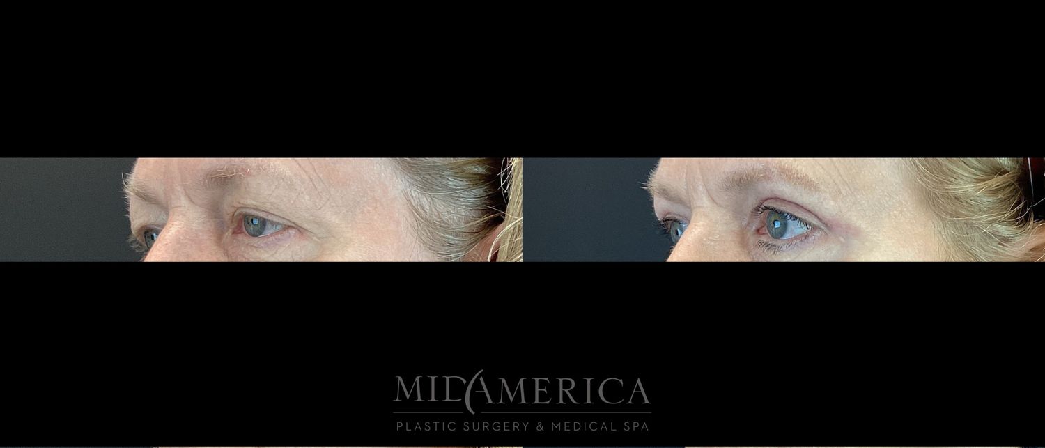 Eyelid Surgery Before & After