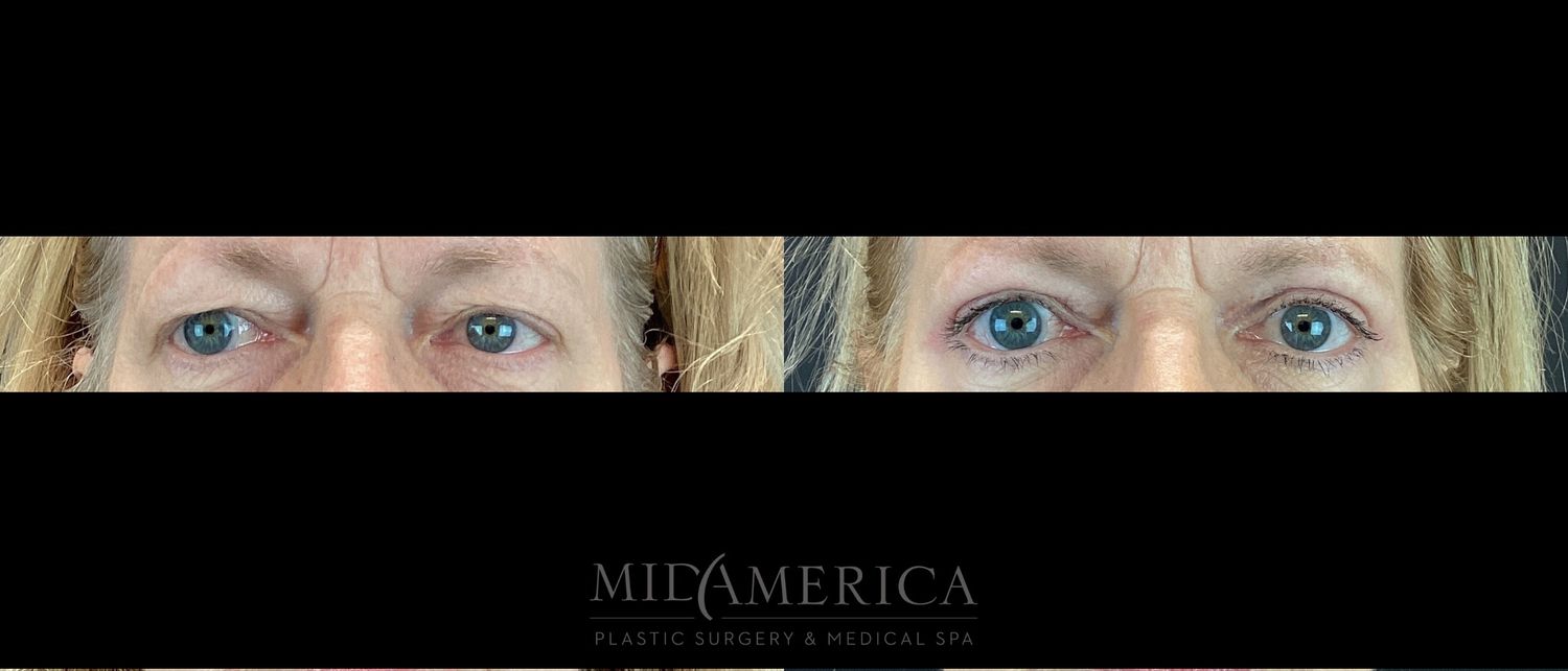 Eyelid Surgery Before & After