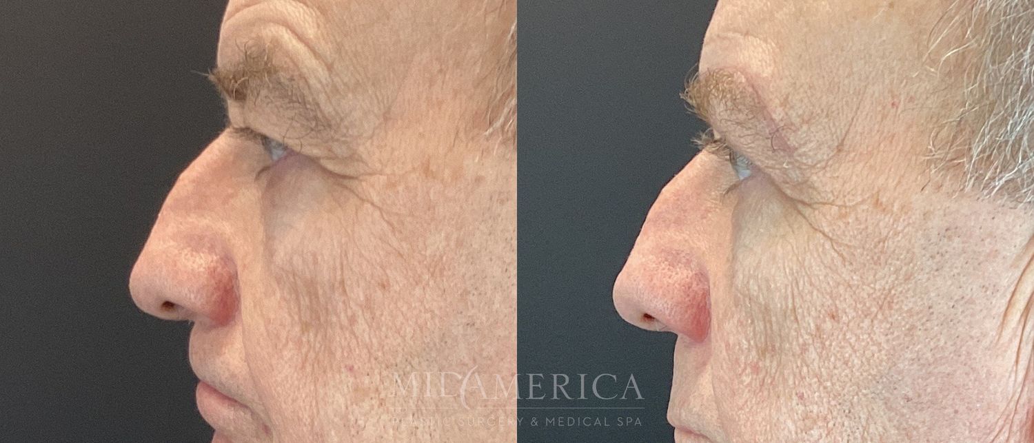 Eyelid Surgery Before & After