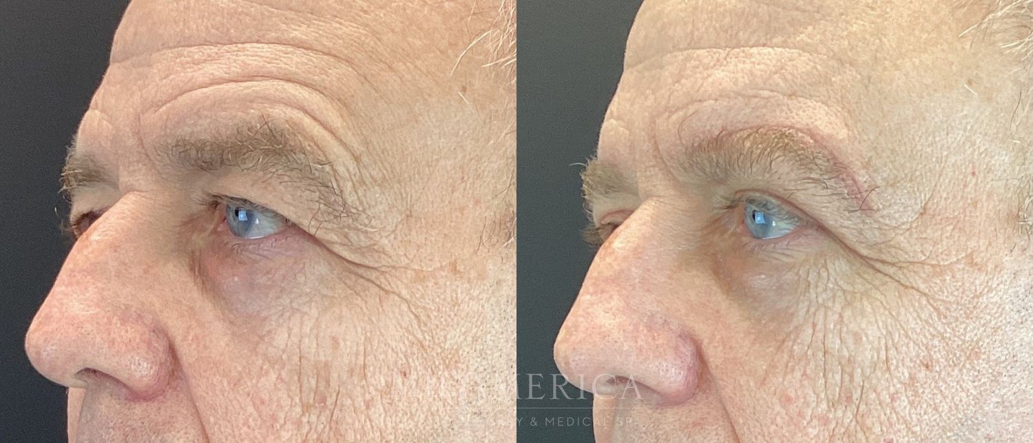 Eyelid Surgery Before & After