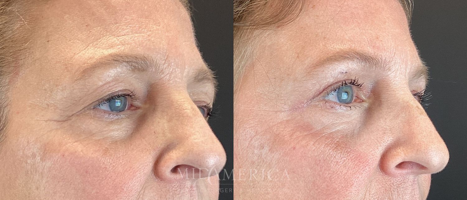 Eyelid Surgery Before & After