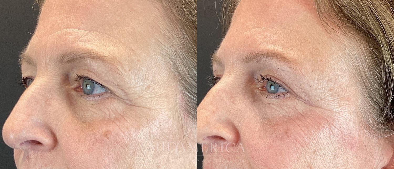 Eyelid Surgery Before & After
