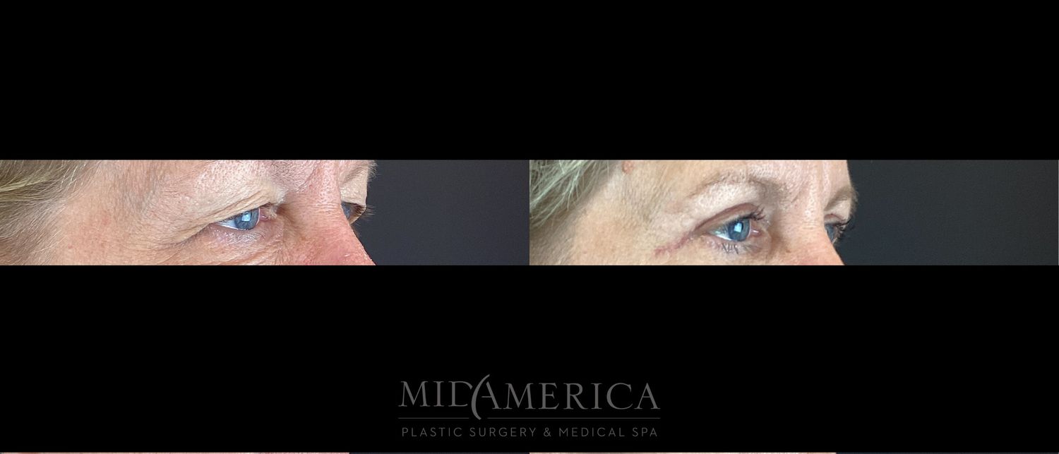 Eyelid Surgery Before & After