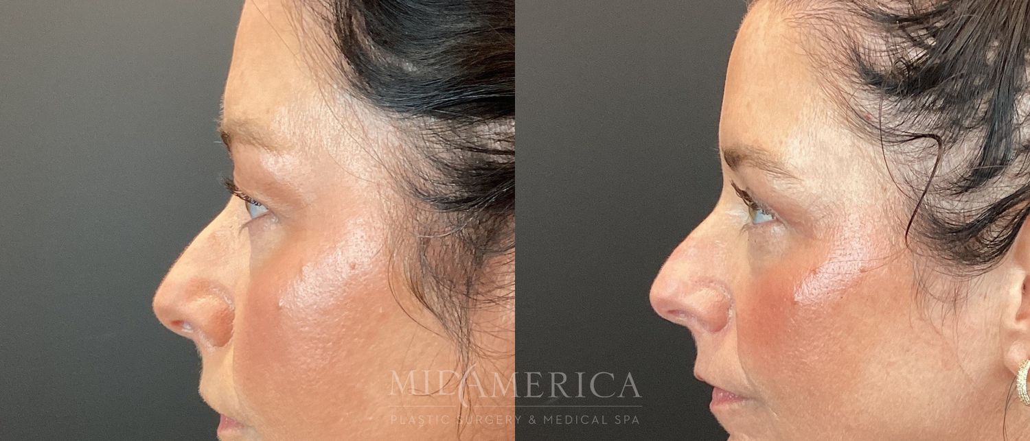 Eyelid Surgery Before & After