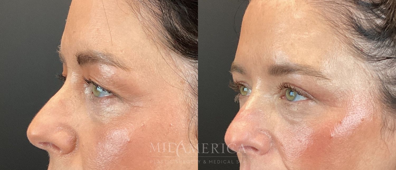 Eyelid Surgery Before & After