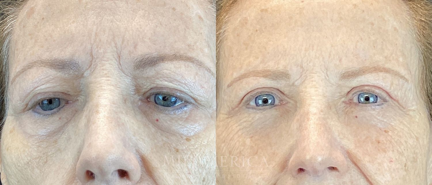 Eyelid Surgery Before & After