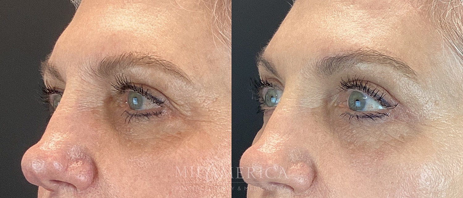 Eyelid Surgery Before & After