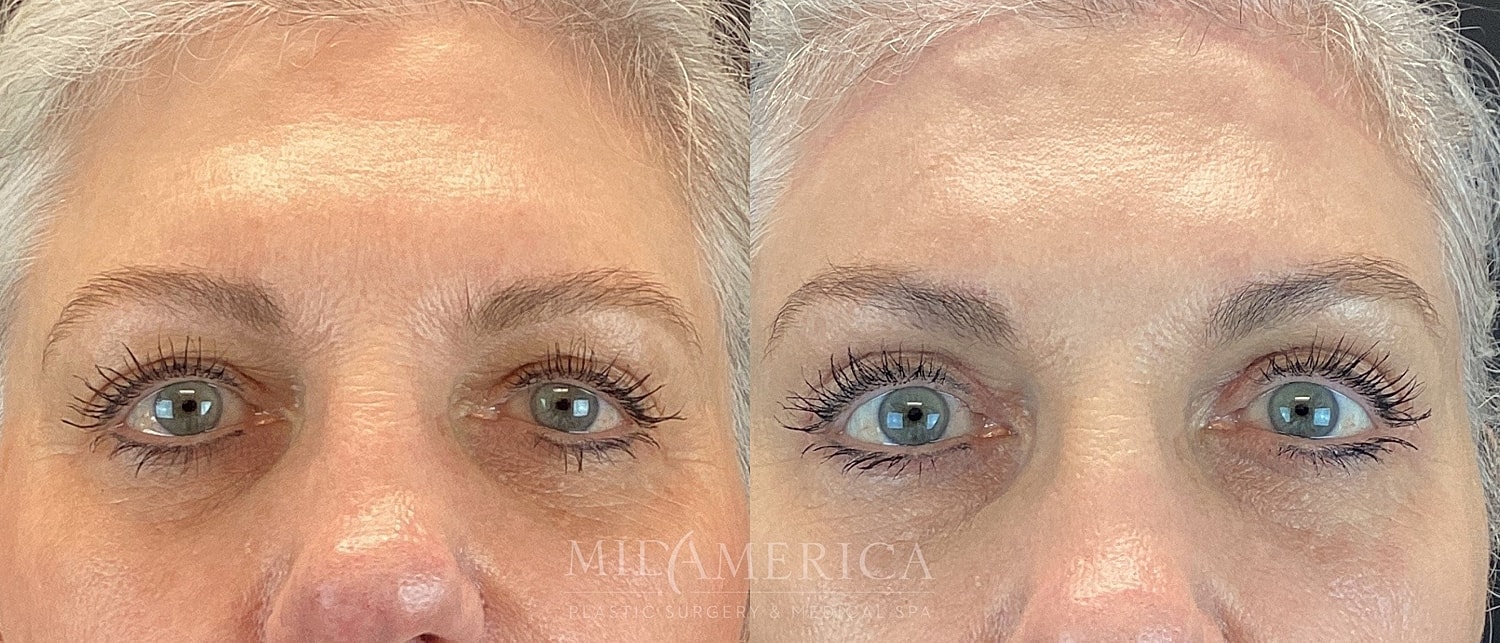 Eyelid Surgery Before & After