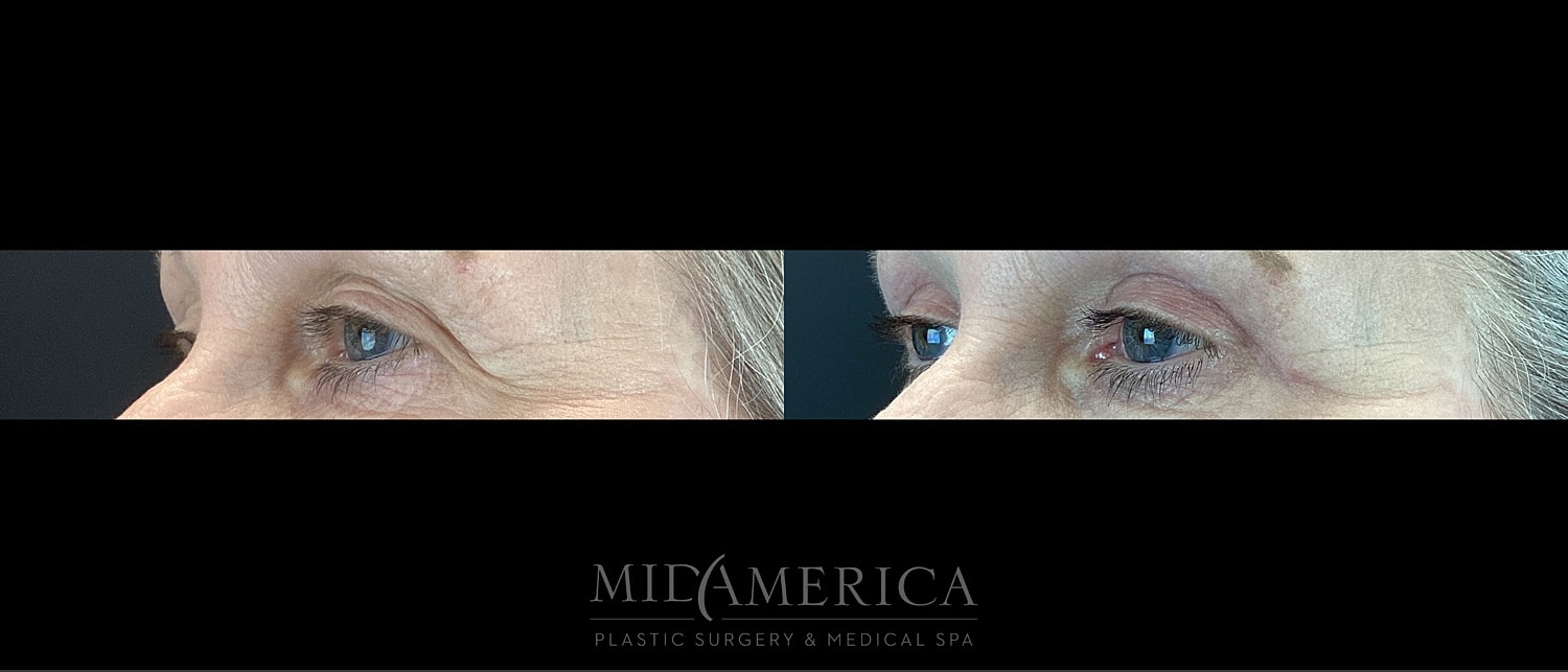 Eyelid Surgery Before & After