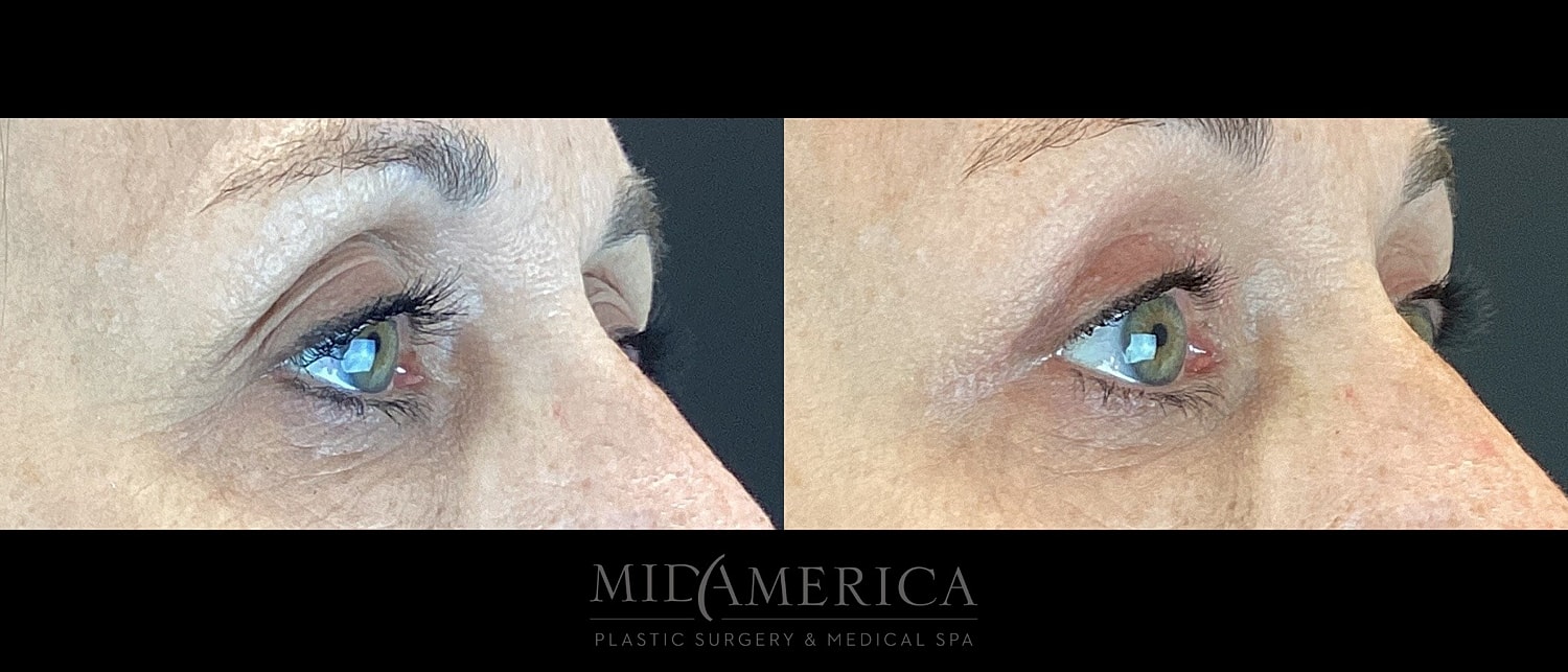 Eyelid Surgery Before & After