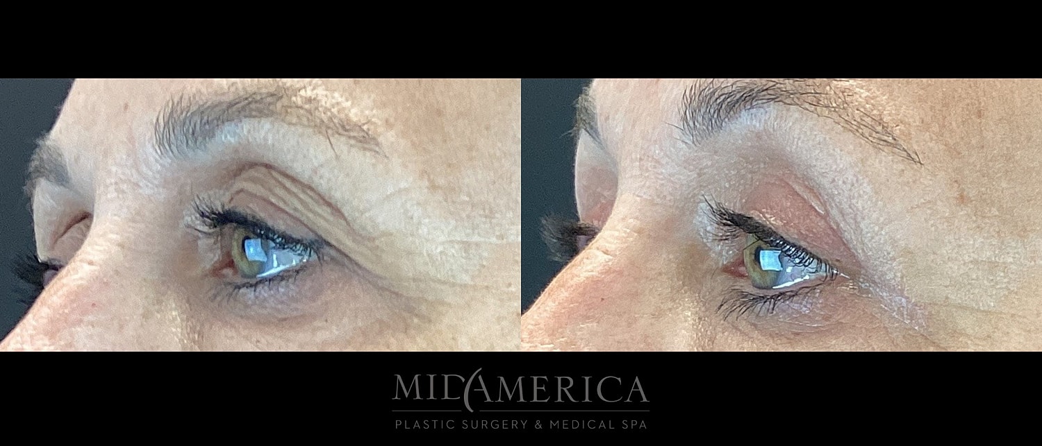 Eyelid Surgery Before & After