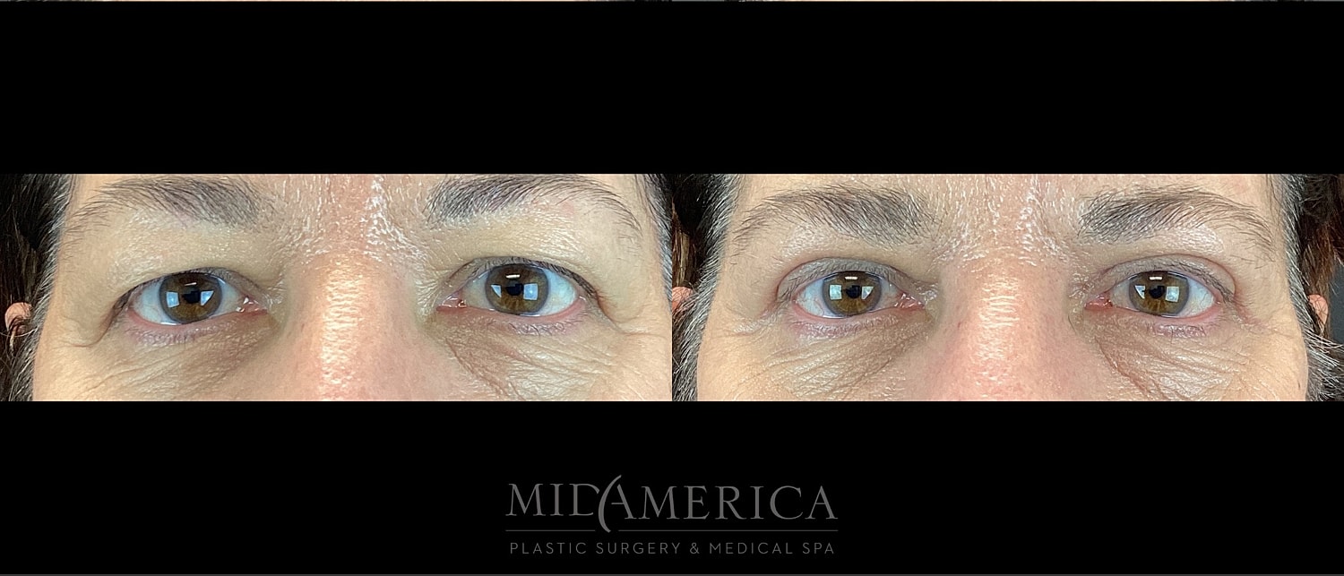 Eyelid Surgery Before & After
