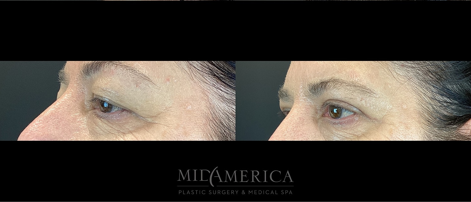Eyelid Surgery Before & After