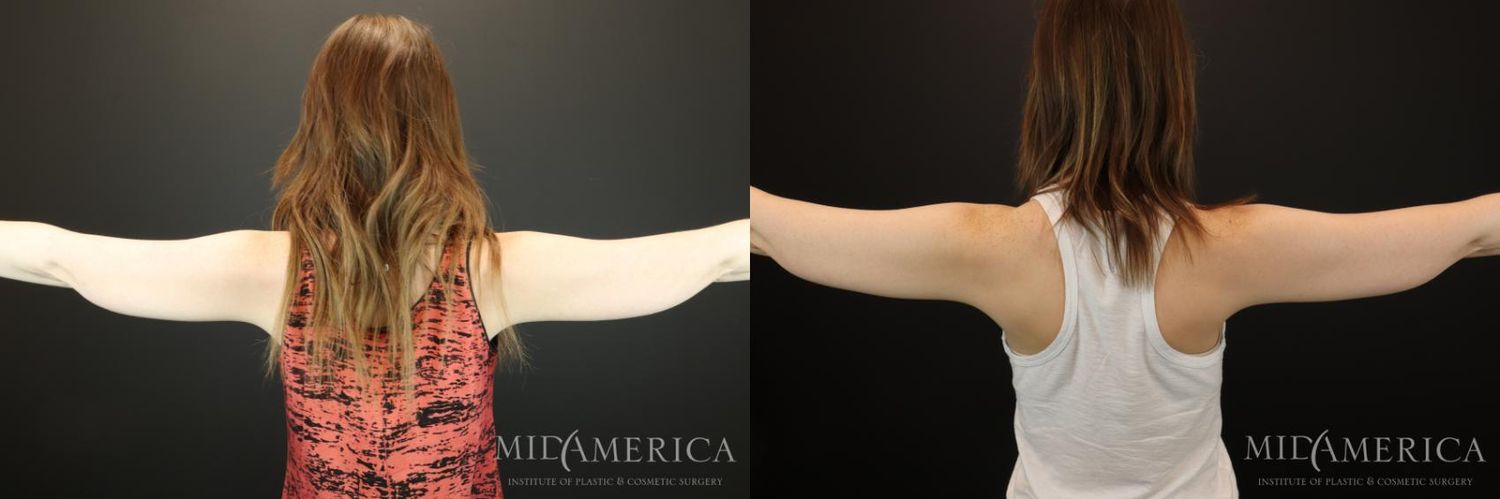 Coolsculpting Before & After