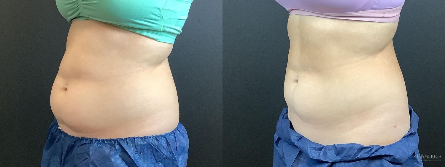 Coolsculpting Before & After