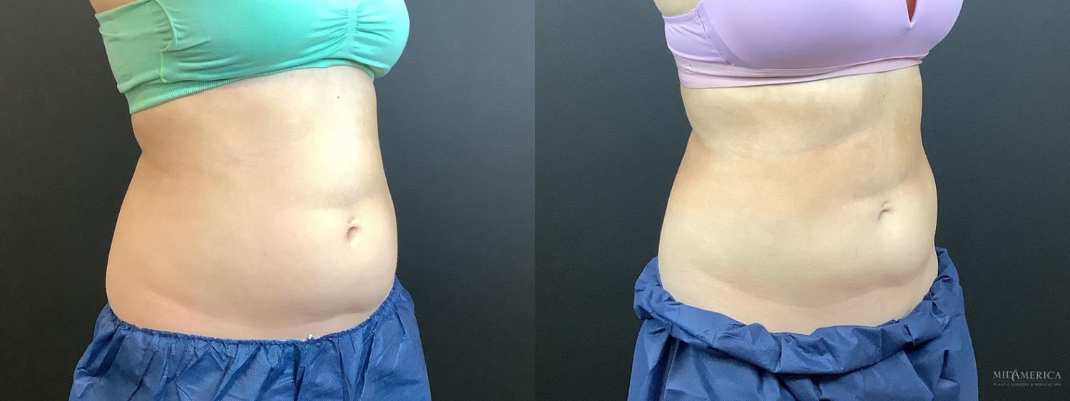 Coolsculpting Before & After