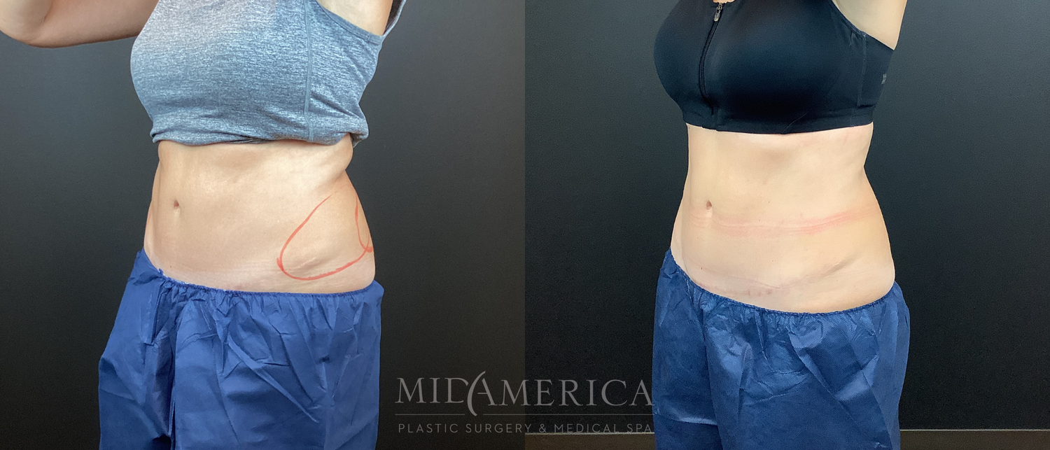 CoolSculpting Before & After