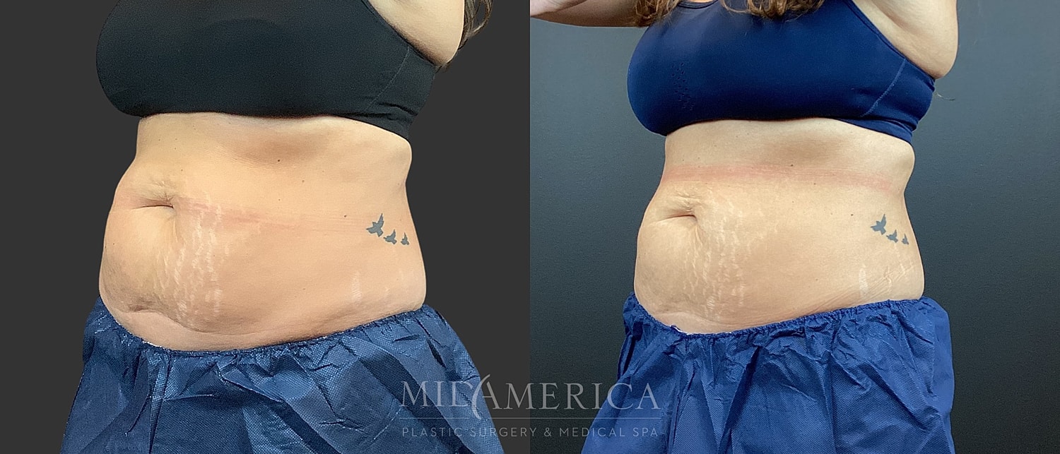 CoolSculpting Before & After