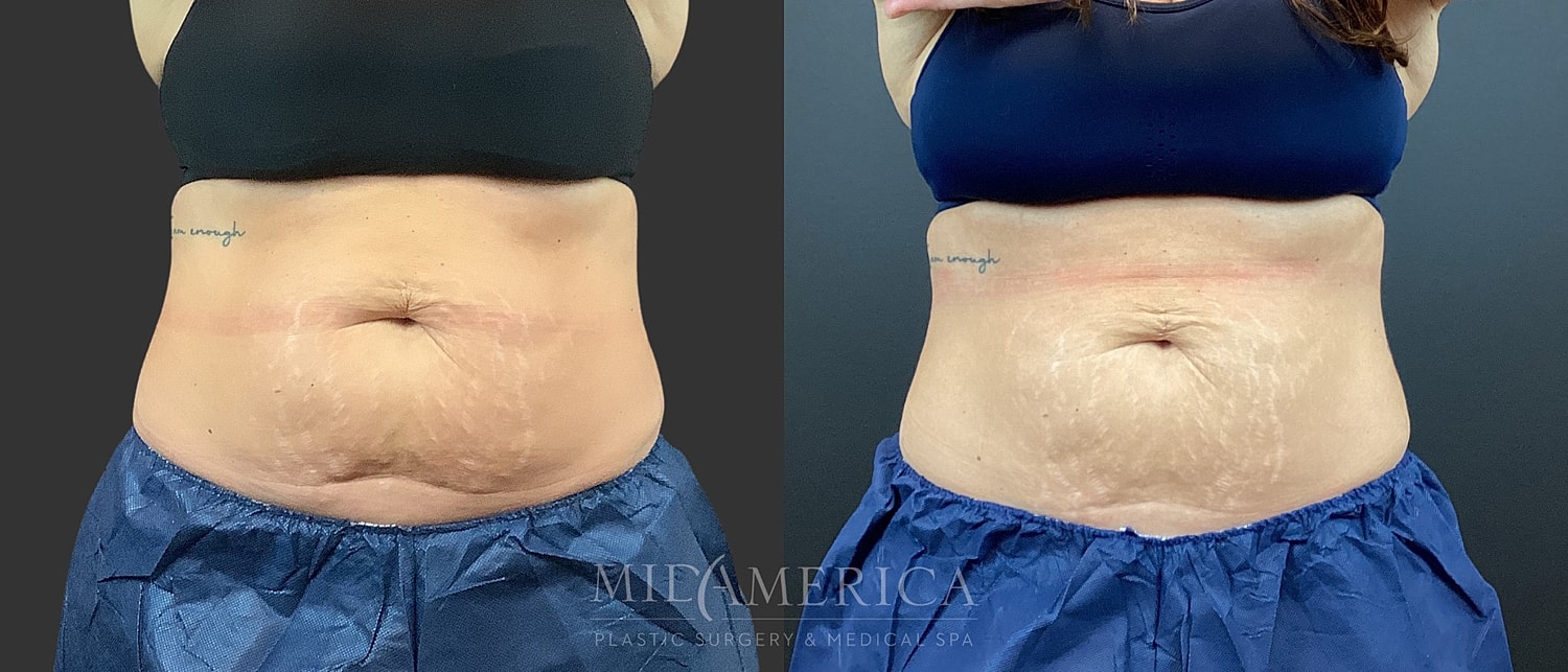 CoolSculpting Before & After
