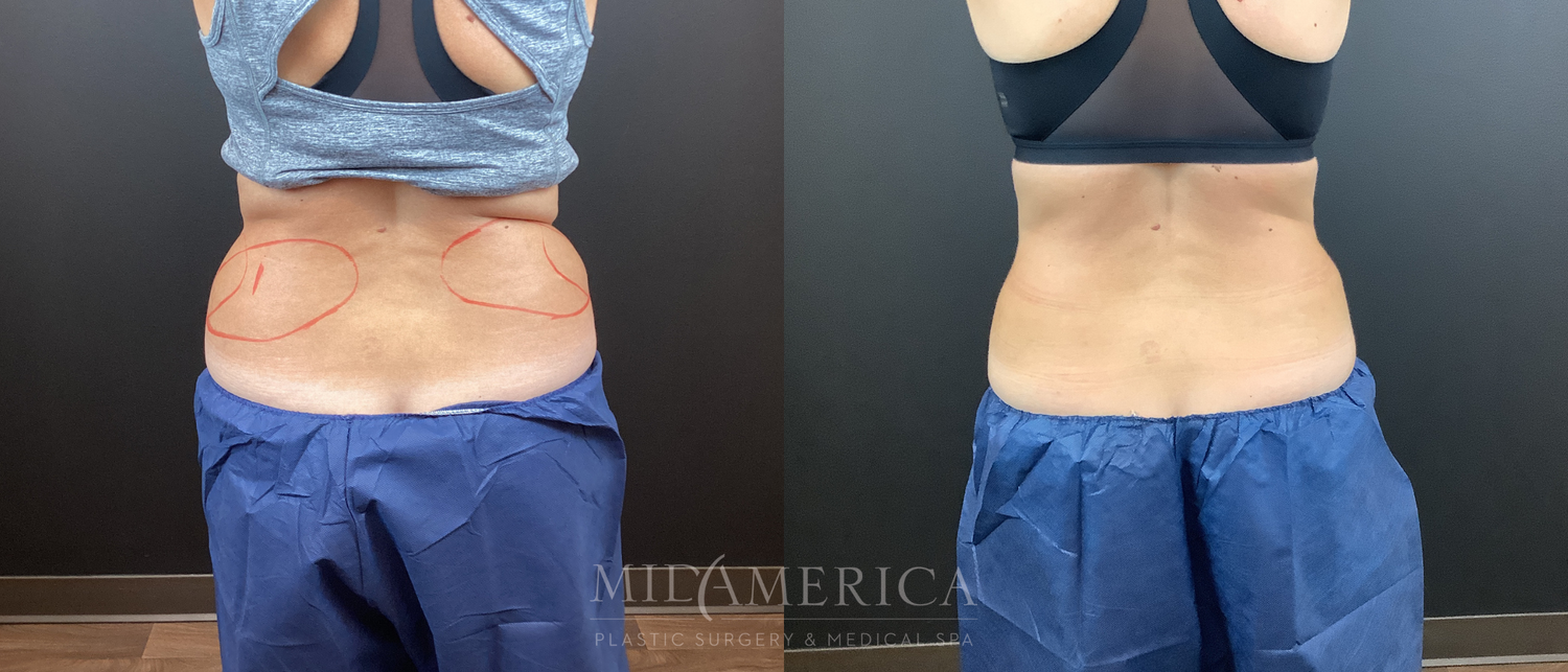 CoolSculpting Before & After