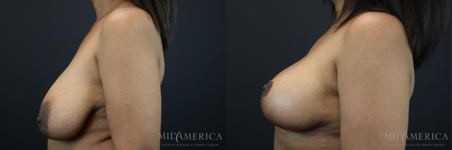 Breast Lift Before & After
