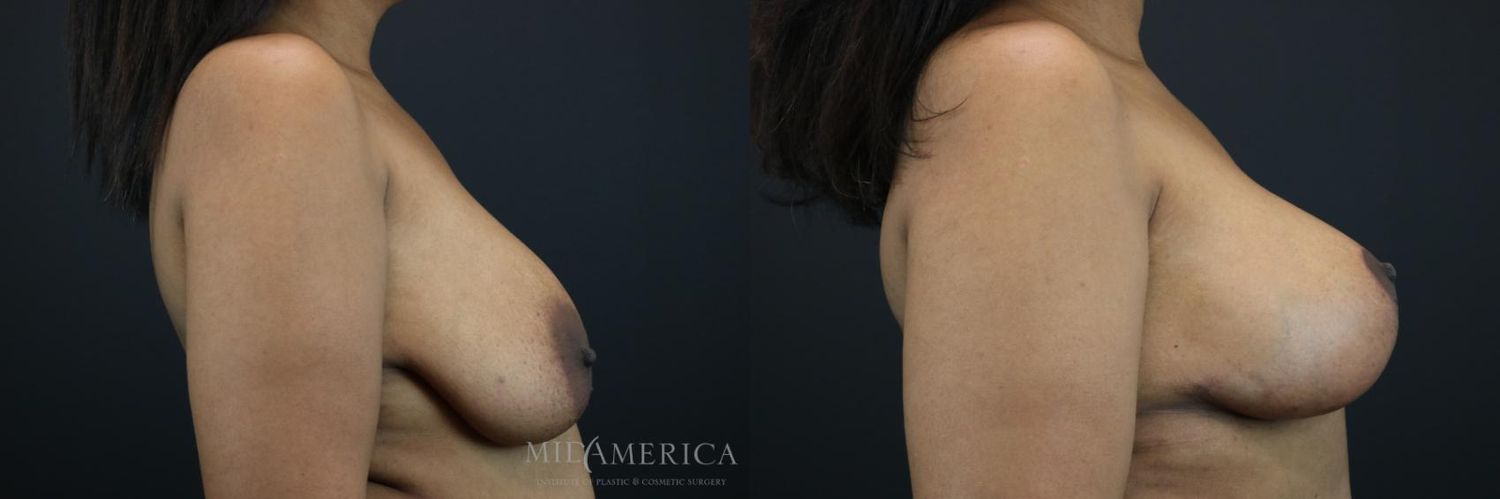 Breast Lift Before & After