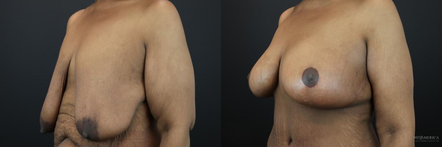 Breast Lift Before & After