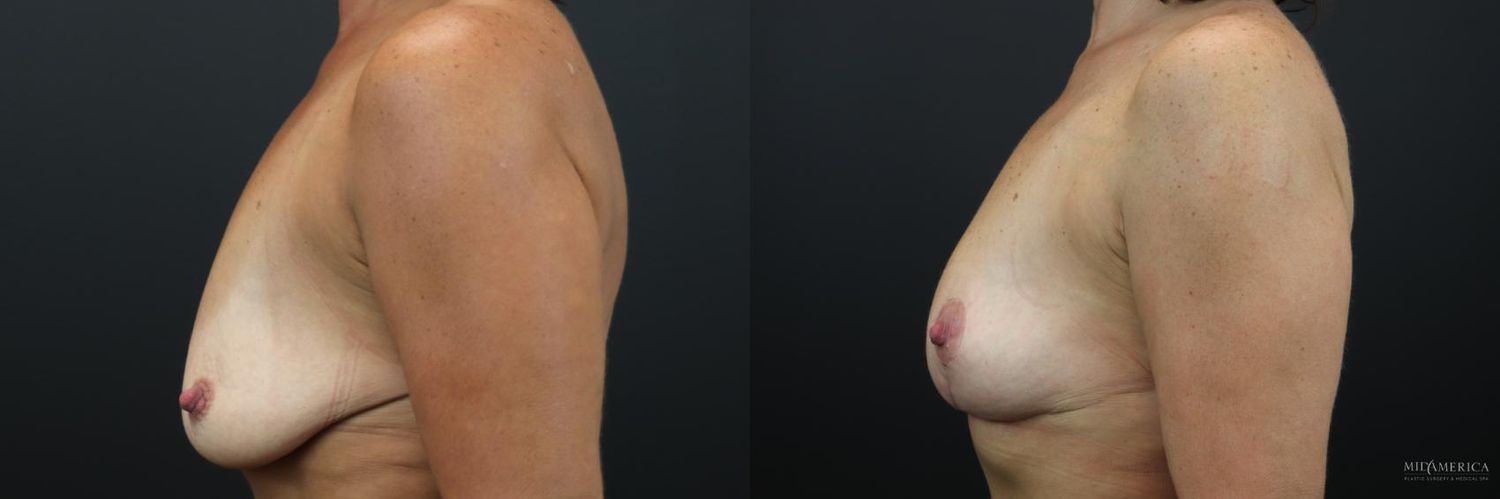 Breast Lift Before & After
