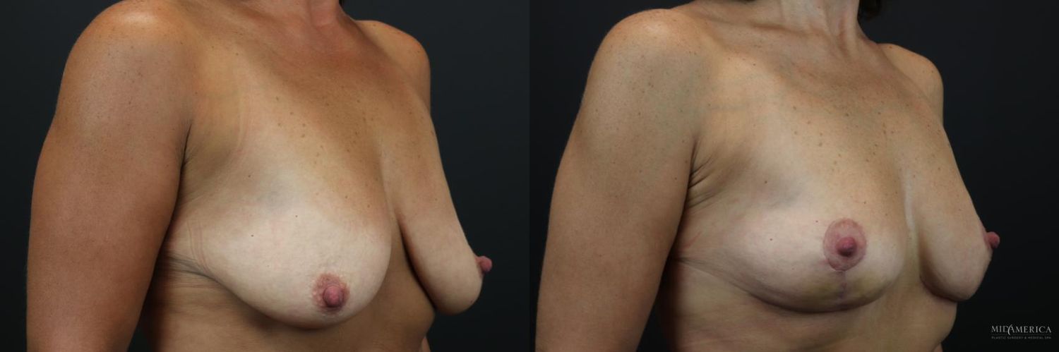 Breast Lift Before & After