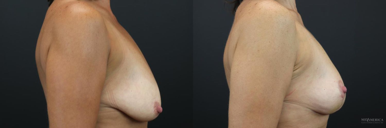 Breast Lift Before & After