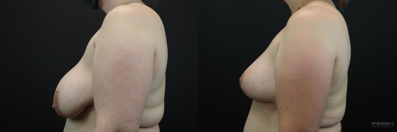Breast Lift Before & After