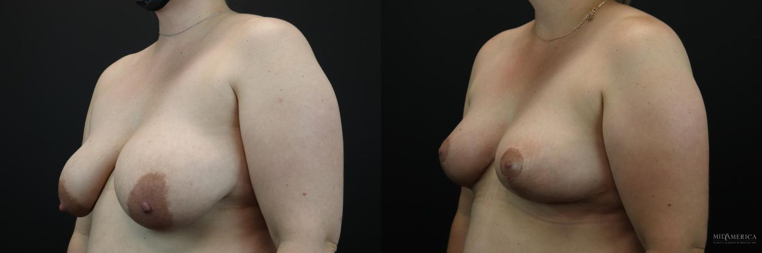 Breast Lift Before & After