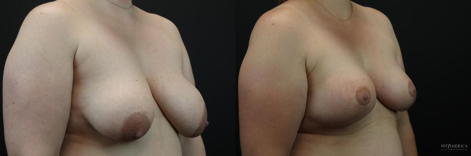 Breast Lift Before & After