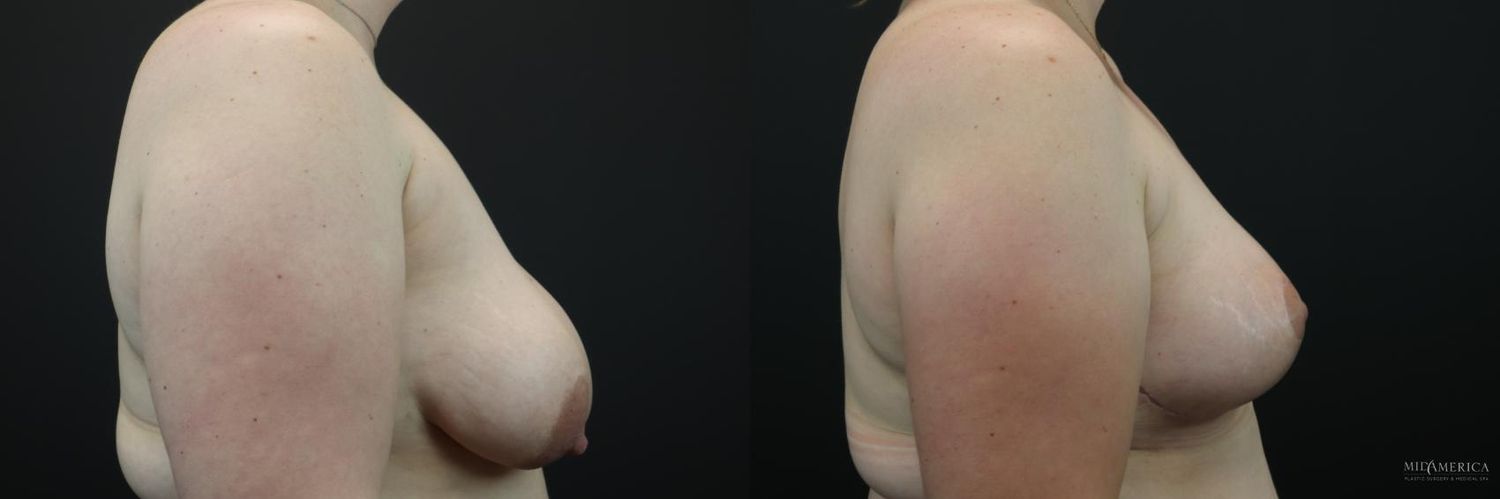 Breast Lift Before & After
