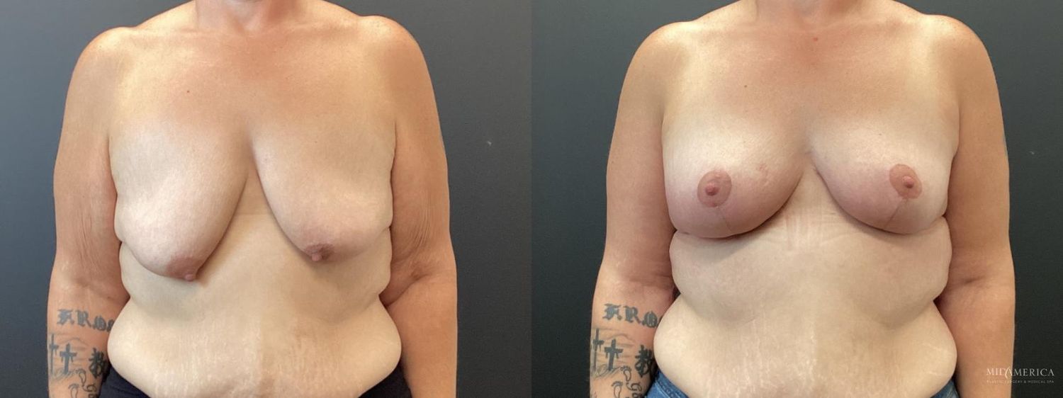 Breast Lift Before & After