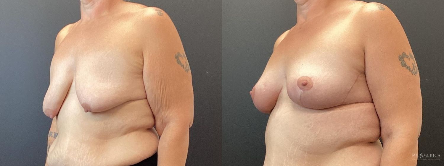 Breast Lift Before & After