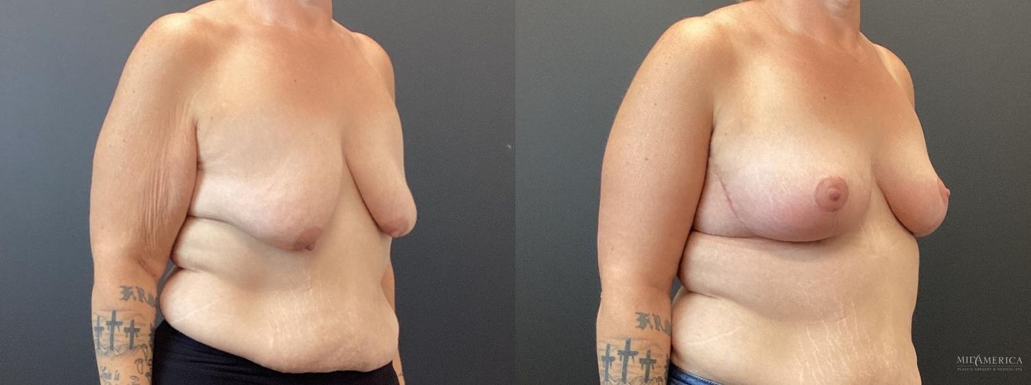 Breast Lift Before & After