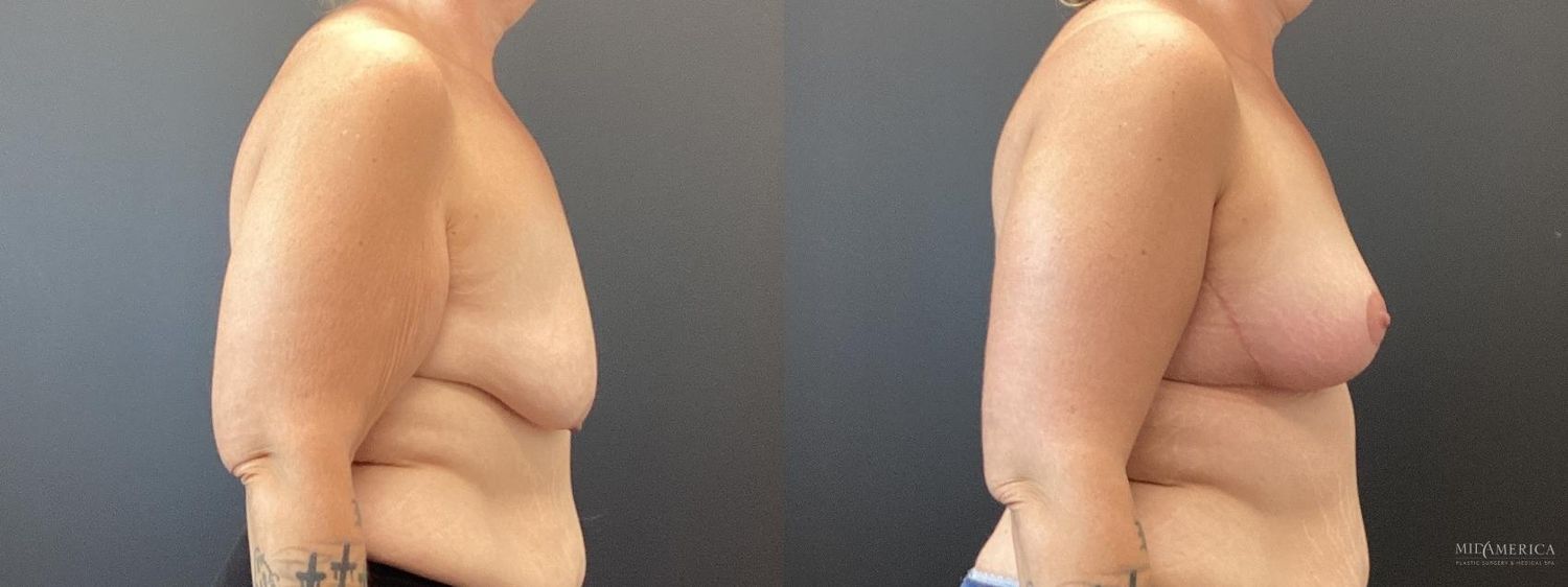 Breast Lift Before & After