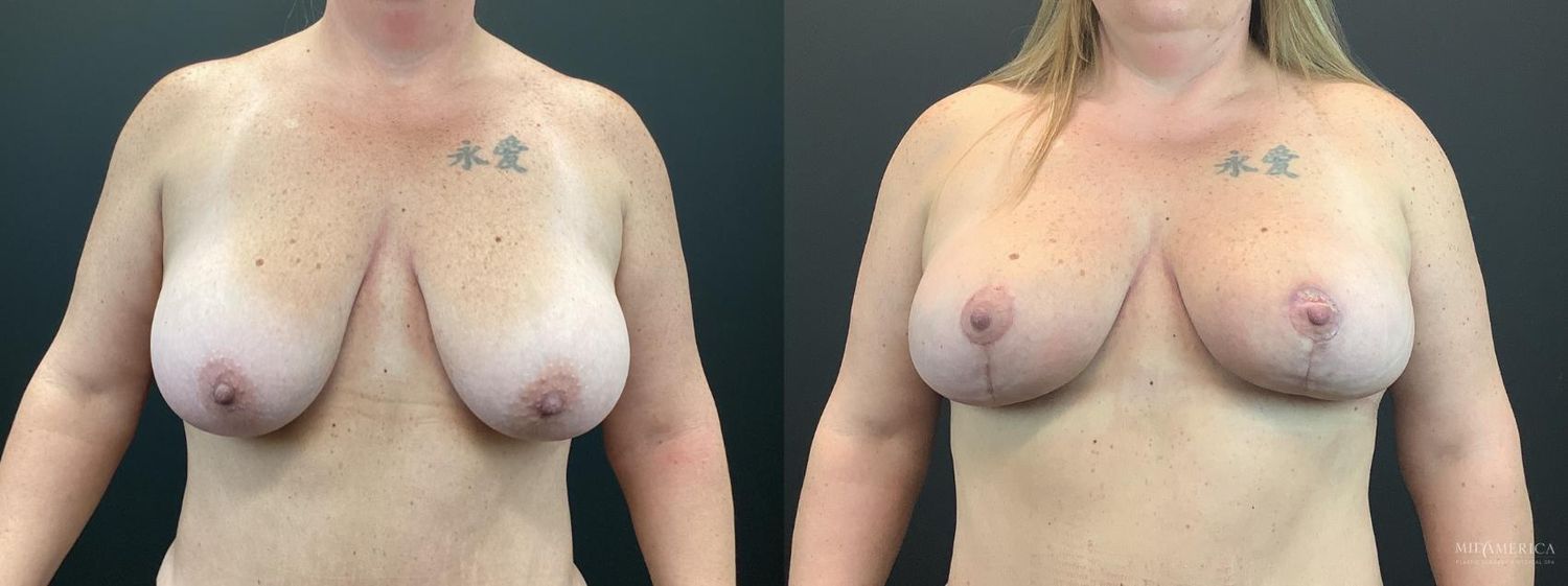 Breast Lift Before & After