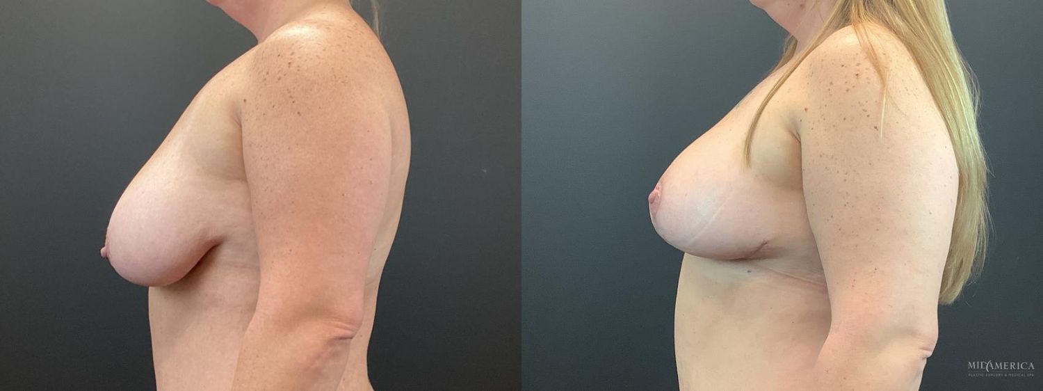 Breast Lift Before & After