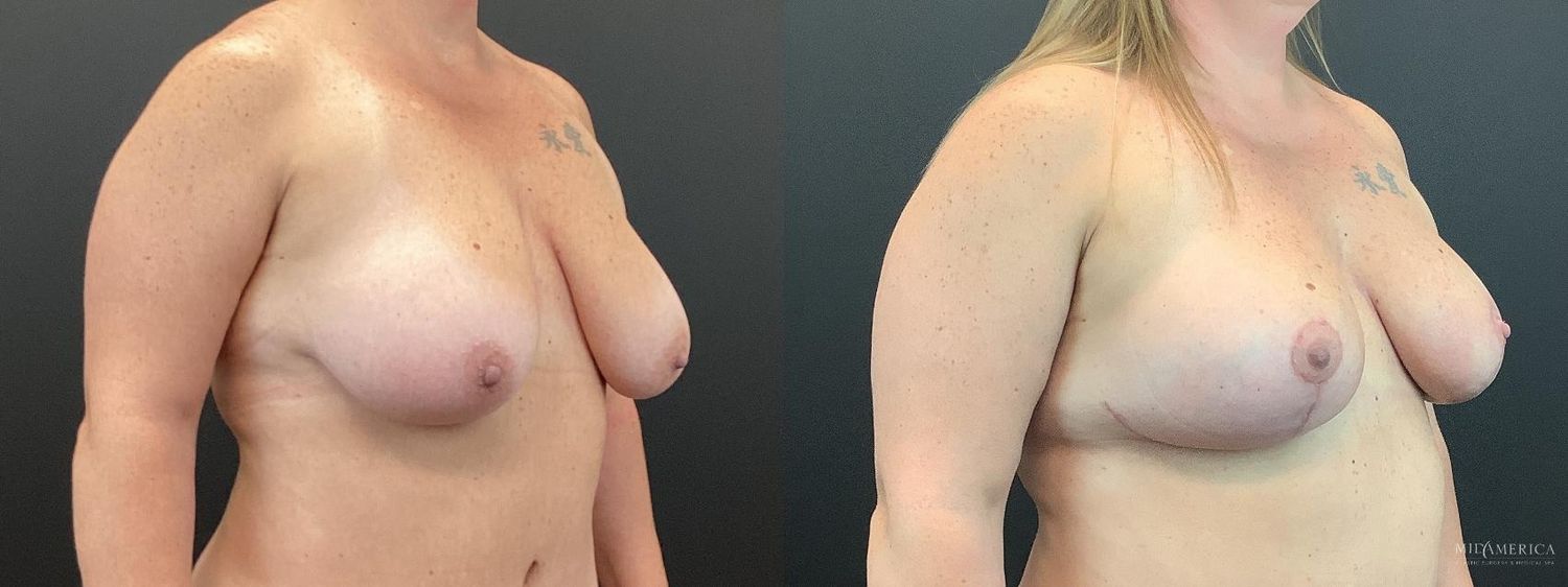 Breast Lift Before & After