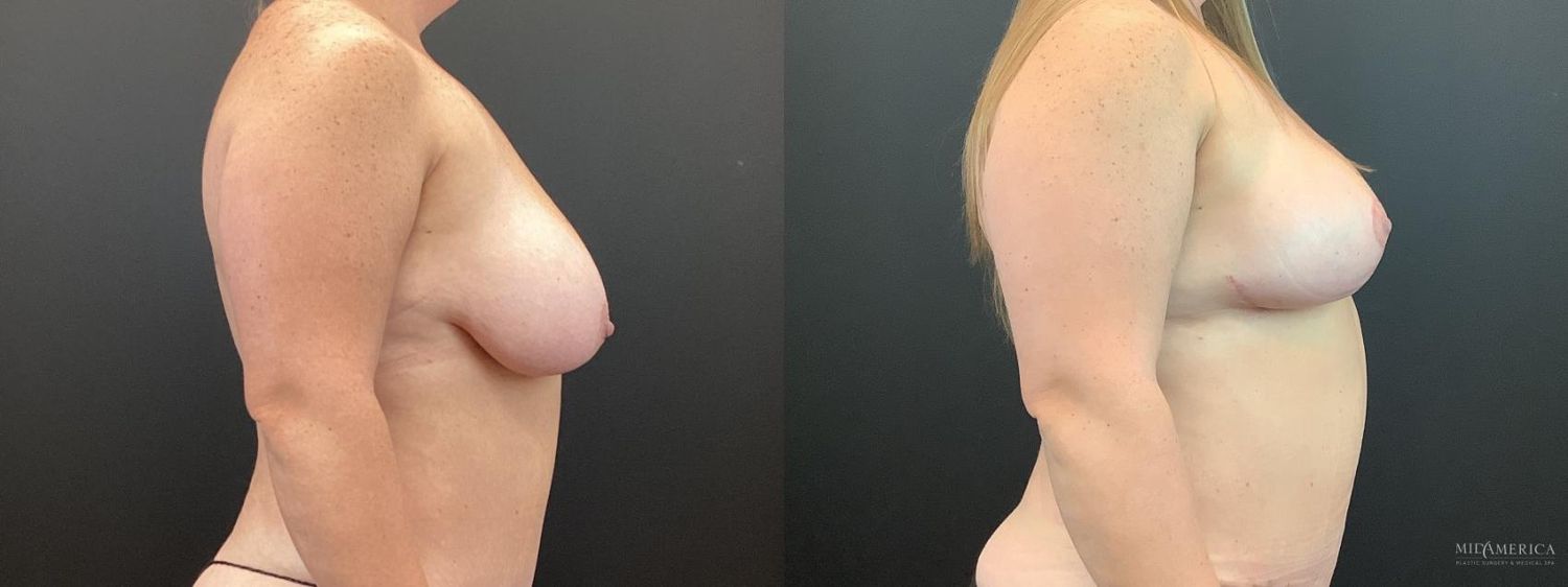 Breast Lift Before & After