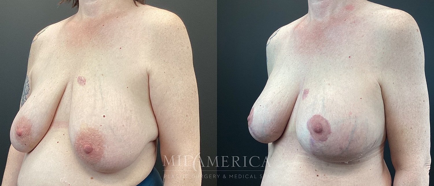 Breast Lift Before & After