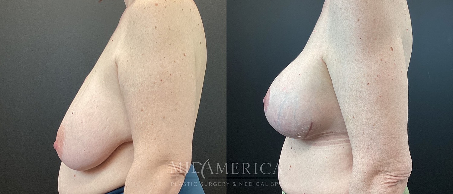 Breast Lift Before & After