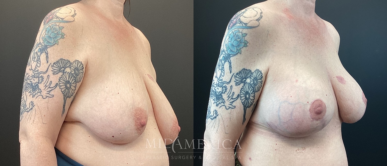 Breast Lift Before & After